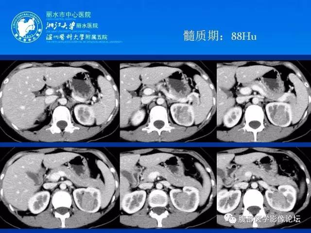 【病例】肾嫌色细胞癌1例CT影像表现 【病例】肾嫌色细胞癌1例CT影像表现