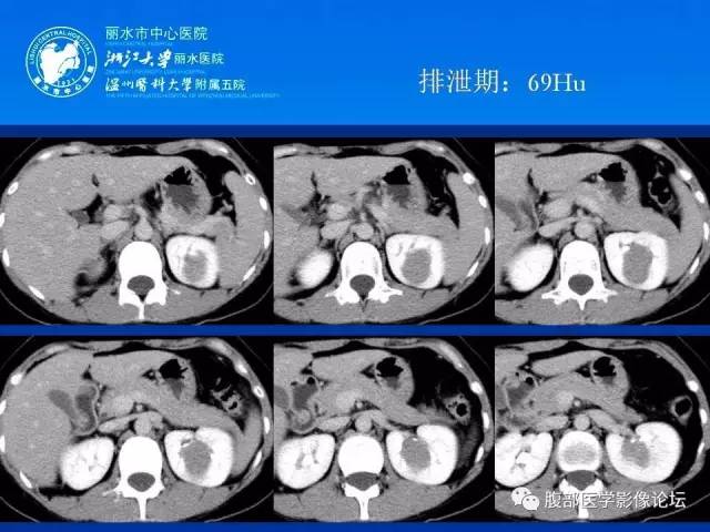 【病例】肾嫌色细胞癌1例CT影像表现 【病例】肾嫌色细胞癌1例CT影像表现