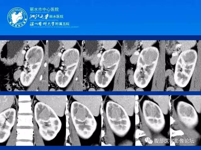 【病例】肾嫌色细胞癌1例CT影像表现 【病例】肾嫌色细胞癌1例CT影像表现
