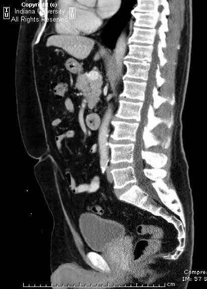 【病例】前列腺腺癌1例MR影像表现 【病例】前列腺腺癌1例MR影像表现