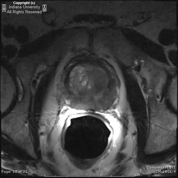 【病例】前列腺腺癌1例MR影像表现