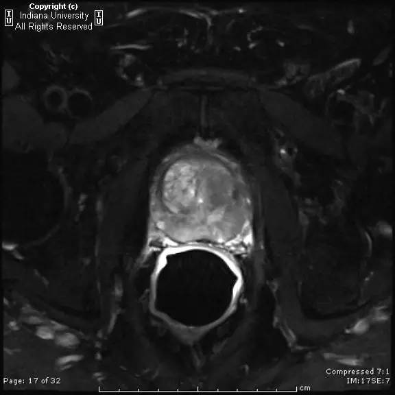 【病例】前列腺腺癌1例MR影像表现 【病例】前列腺腺癌1例MR影像表现
