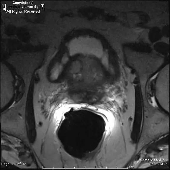 【病例】前列腺腺癌1例MR影像表现 【病例】前列腺腺癌1例MR影像表现