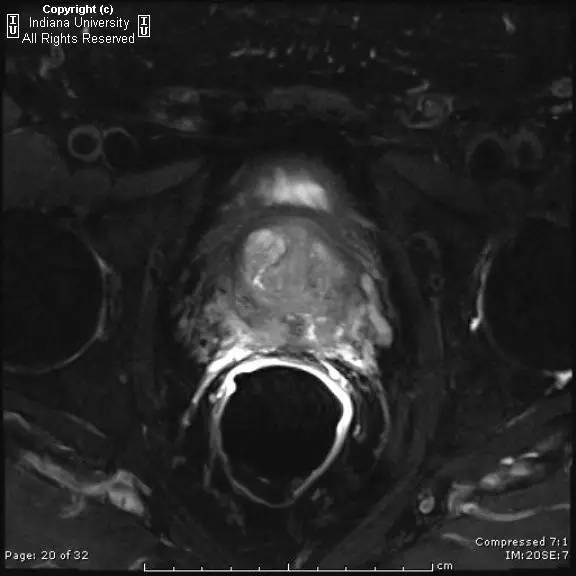 【病例】前列腺腺癌1例MR影像表现 【病例】前列腺腺癌1例MR影像表现