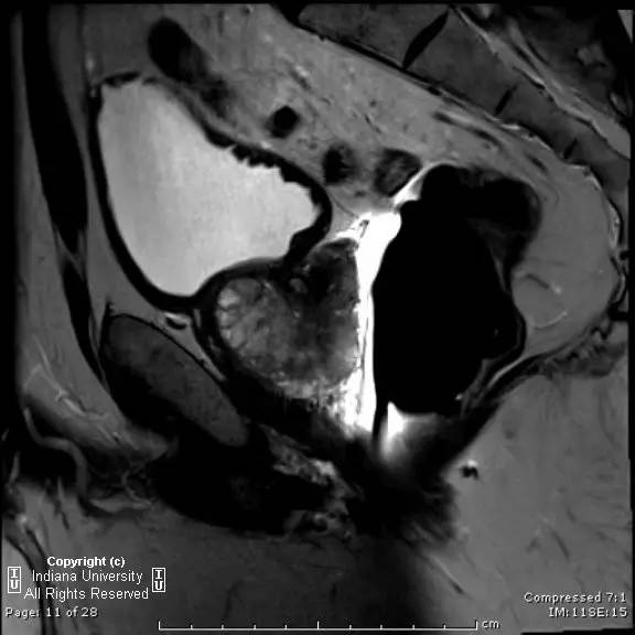 【病例】前列腺腺癌1例MR影像表现 【病例】前列腺腺癌1例MR影像表现