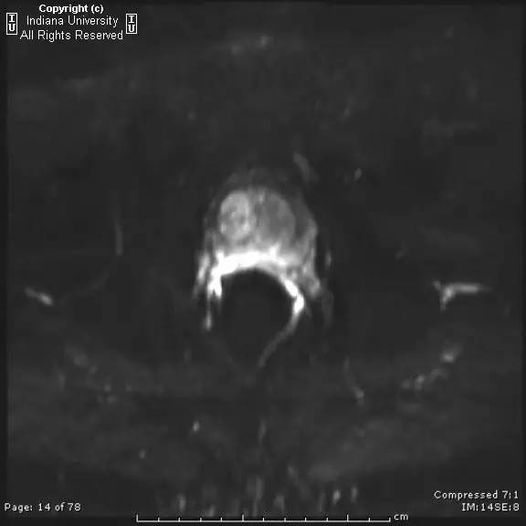 【病例】前列腺腺癌1例MR影像表现 【病例】前列腺腺癌1例MR影像表现