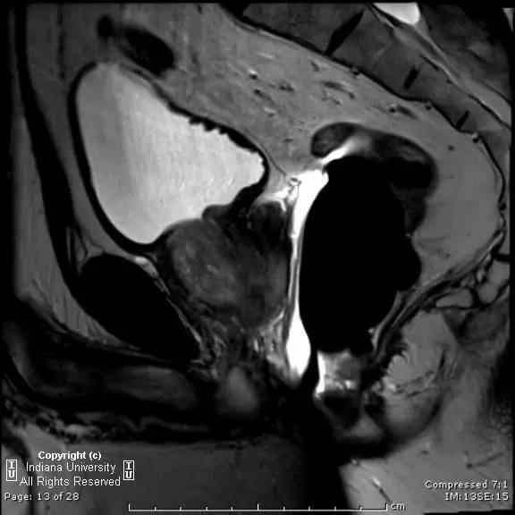 【病例】前列腺腺癌1例MR影像表现 【病例】前列腺腺癌1例MR影像表现