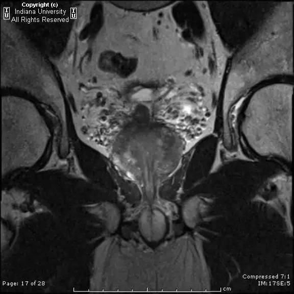 【病例】前列腺腺癌1例MR影像表现 【病例】前列腺腺癌1例MR影像表现