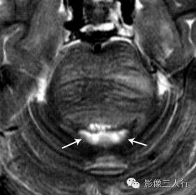 "第四脑室平底征"，这个征象提示啥？