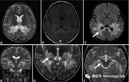 可逆性后部脑病综合征影像学的常见和少见表现 可逆性后部脑病综合征影像学的常见和少见表现