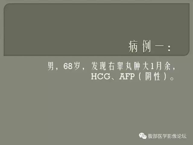 【病例】睾丸淋巴瘤VS精原细胞瘤