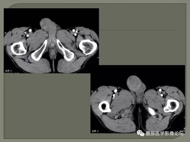 【病例】睾丸淋巴瘤VS精原细胞瘤 【病例】睾丸淋巴瘤VS精原细胞瘤