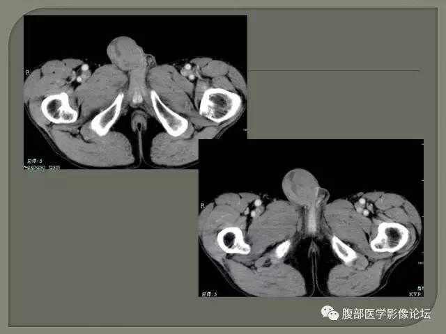 【病例】睾丸淋巴瘤VS精原细胞瘤 【病例】睾丸淋巴瘤VS精原细胞瘤