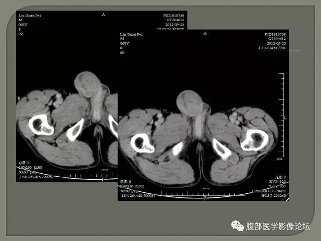 【病例】睾丸淋巴瘤VS精原细胞瘤 【病例】睾丸淋巴瘤VS精原细胞瘤