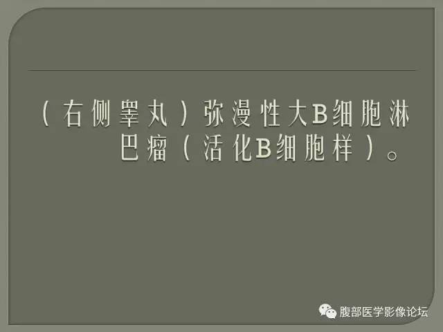 【病例】睾丸淋巴瘤VS精原细胞瘤 【病例】睾丸淋巴瘤VS精原细胞瘤