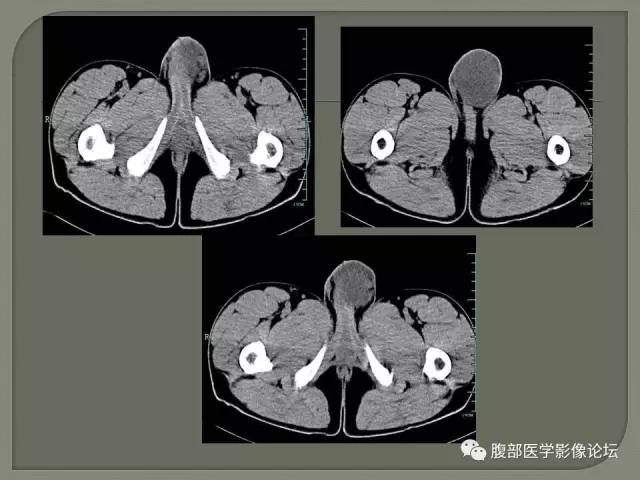 【病例】睾丸淋巴瘤VS精原细胞瘤 【病例】睾丸淋巴瘤VS精原细胞瘤