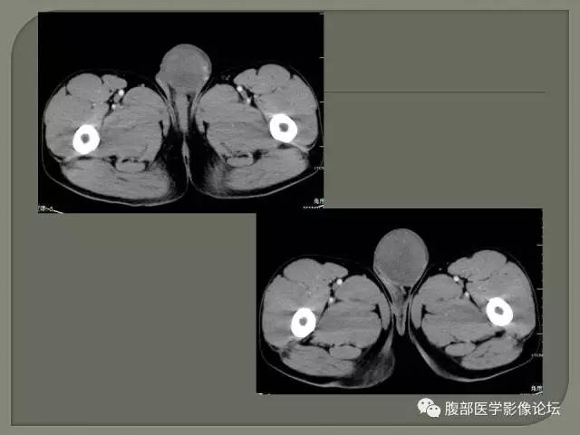 【病例】睾丸淋巴瘤VS精原细胞瘤 【病例】睾丸淋巴瘤VS精原细胞瘤