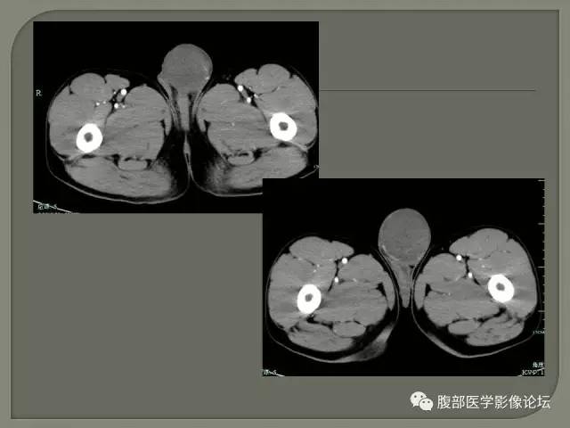 【病例】睾丸淋巴瘤VS精原细胞瘤 【病例】睾丸淋巴瘤VS精原细胞瘤