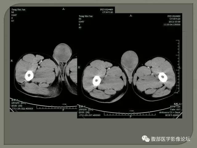 【病例】睾丸淋巴瘤VS精原细胞瘤 【病例】睾丸淋巴瘤VS精原细胞瘤