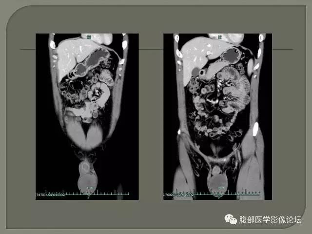 【病例】睾丸淋巴瘤VS精原细胞瘤 【病例】睾丸淋巴瘤VS精原细胞瘤