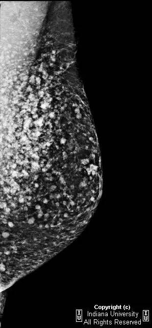【病例】乳腺硅胶肉芽肿1例X线影像表现