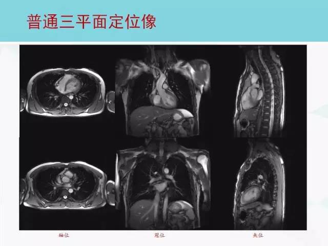 【PPT】心脏MRI定位攻略