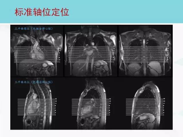 【PPT】心脏MRI定位攻略