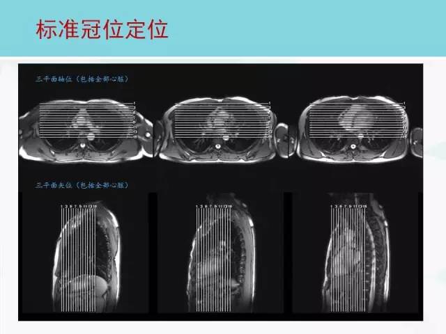 【PPT】心脏MRI定位攻略