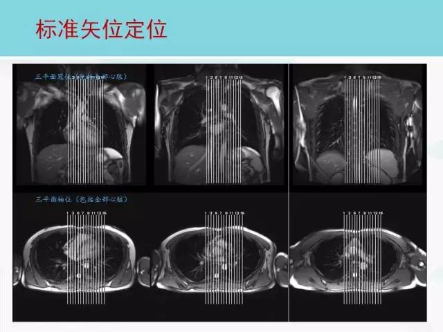 【PPT】心脏MRI定位攻略