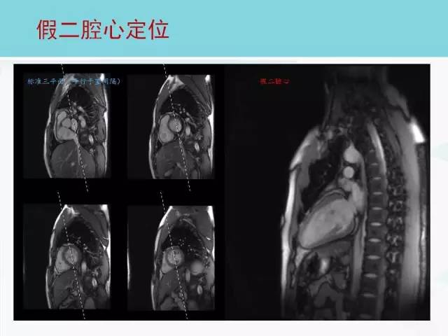 【PPT】心脏MRI定位攻略
