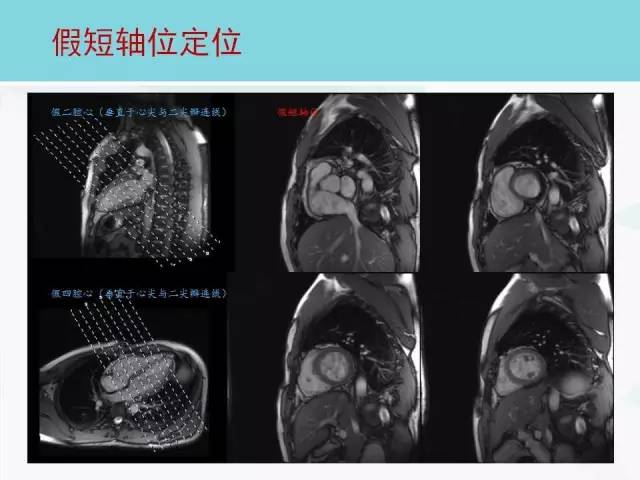 【PPT】心脏MRI定位攻略