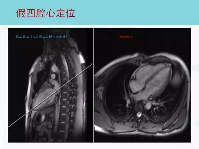 【PPT】心脏MRI定位攻略