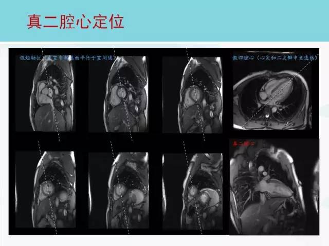 【PPT】心脏MRI定位攻略