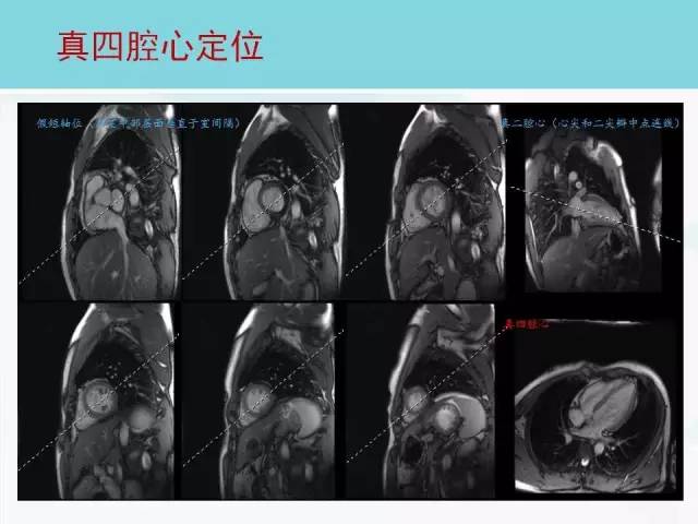 【PPT】心脏MRI定位攻略