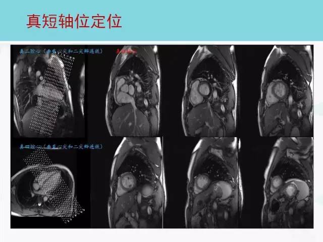 【PPT】心脏MRI定位攻略
