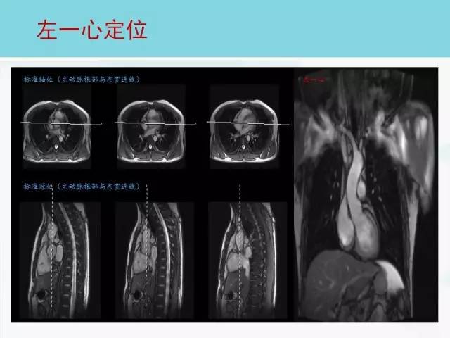 【PPT】心脏MRI定位攻略