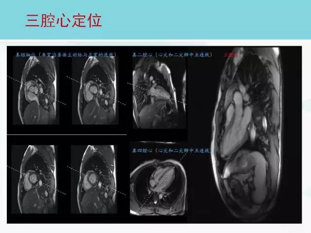 【PPT】心脏MRI定位攻略