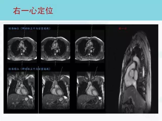 【PPT】心脏MRI定位攻略