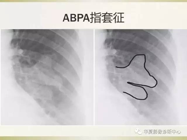 【PPT】指套征——支气管粘液嵌塞征