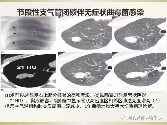 【PPT】指套征——支气管粘液嵌塞征