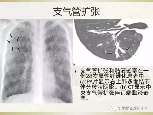 【PPT】指套征——支气管粘液嵌塞征