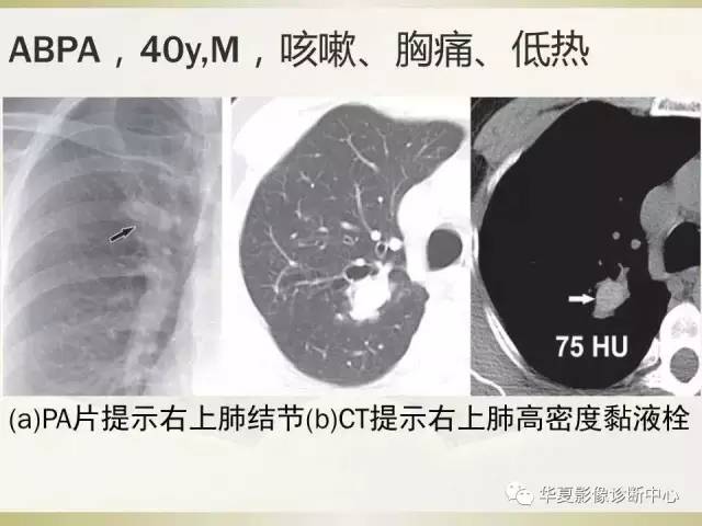 【PPT】指套征——支气管粘液嵌塞征