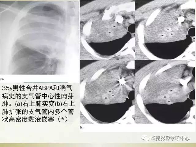 【PPT】指套征——支气管粘液嵌塞征