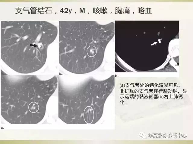 【PPT】指套征——支气管粘液嵌塞征