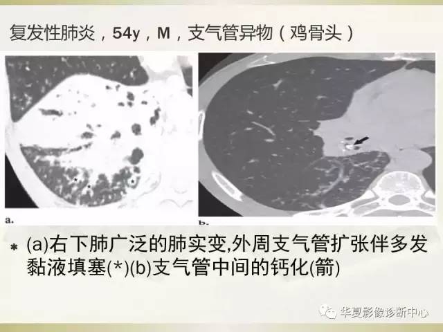 【PPT】指套征——支气管粘液嵌塞征