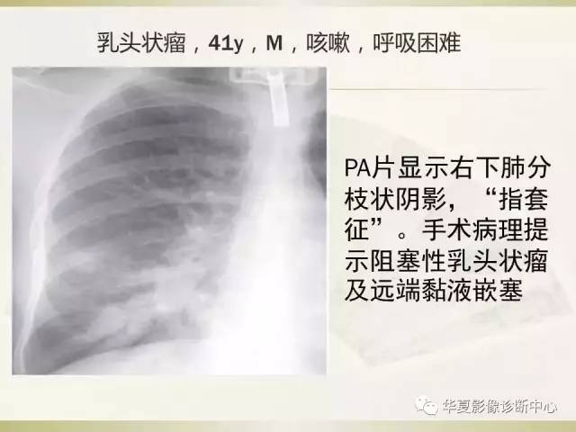 【PPT】指套征——支气管粘液嵌塞征