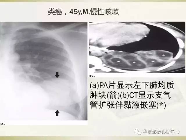 【PPT】指套征——支气管粘液嵌塞征