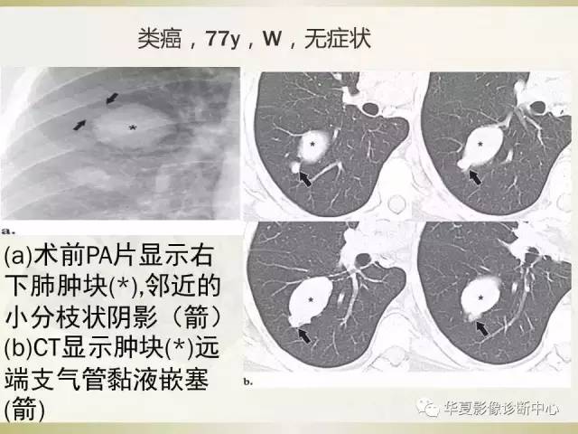 【PPT】指套征——支气管粘液嵌塞征