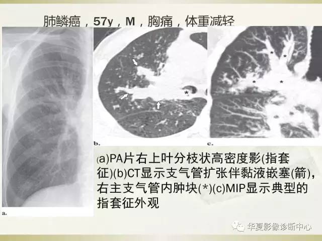 【PPT】指套征——支气管粘液嵌塞征
