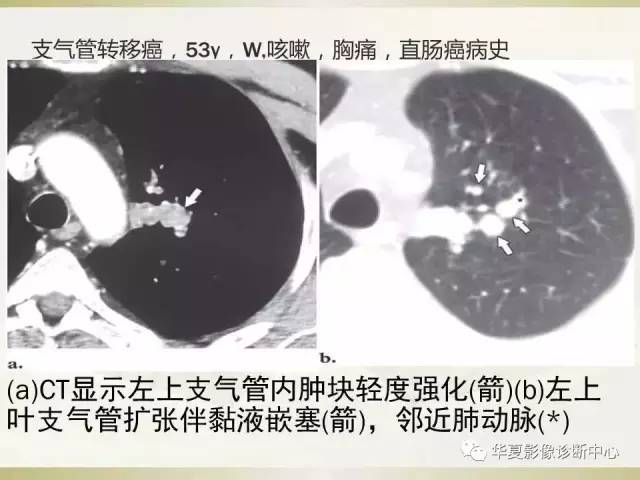 【PPT】指套征——支气管粘液嵌塞征